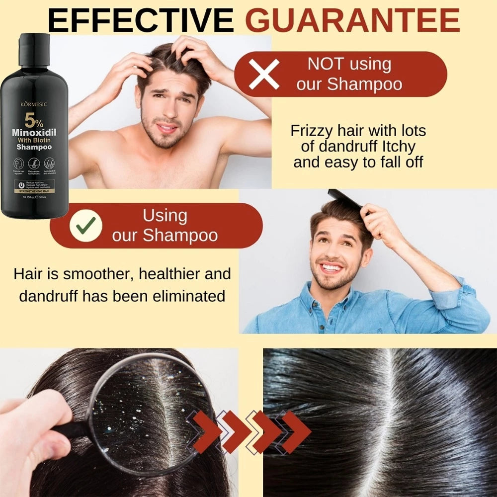Minoxidil 5% Hair Grower Shampoo with Biotin for Hair Loss Treatment Regrowth Hair