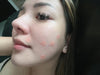Rosmar Pimple Patch / Acne Patch
