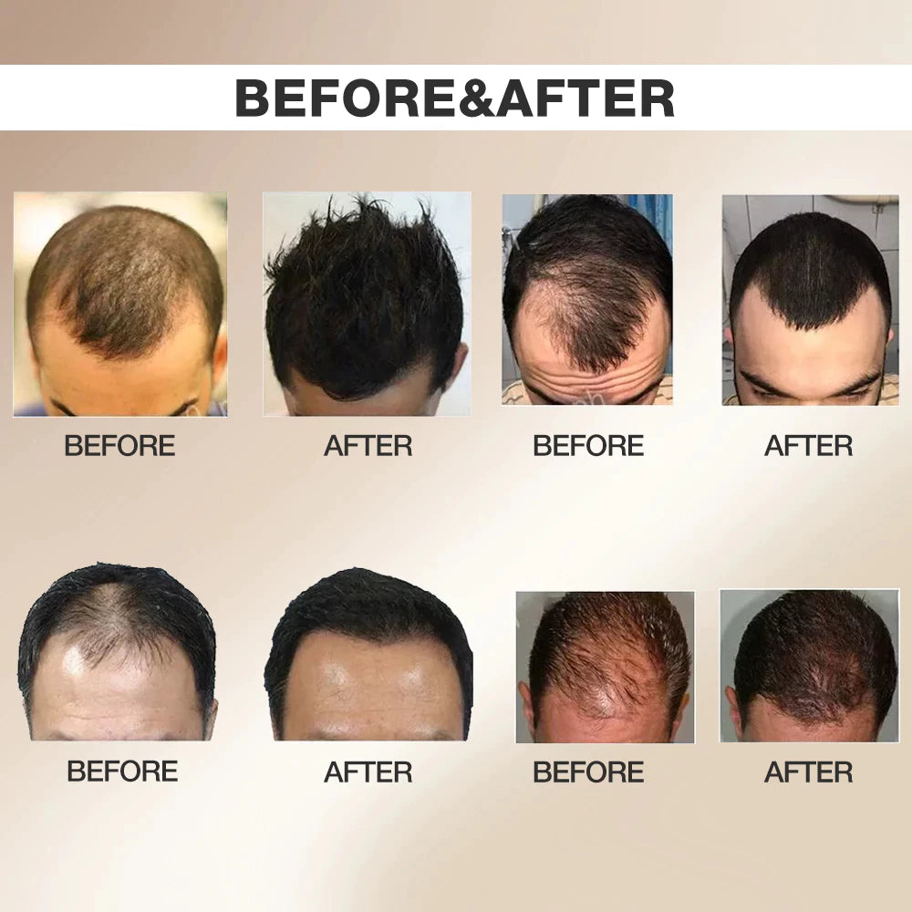 5% Minoxidil Biotin Hair Grower Spray 30ml - DHT Blocker For Hair Loss Treatment