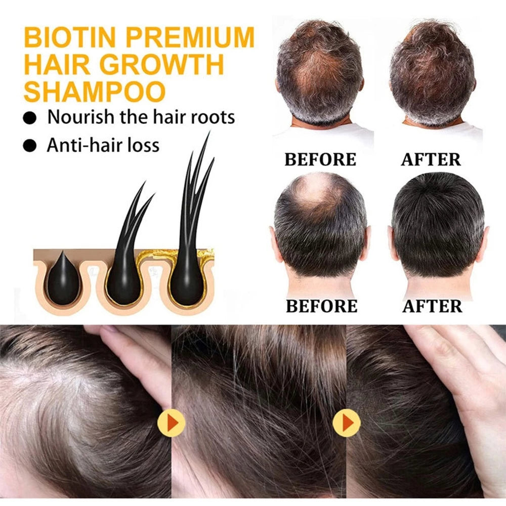 Minoxidil 5% Hair Grower Shampoo with Biotin for Hair Loss Treatment Regrowth Hair